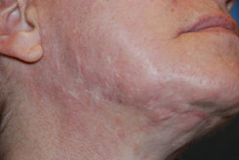 Scar Revision Before & After Gallery - Patient 428116 - Image 3