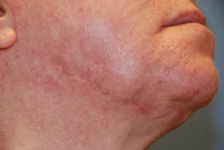 Scar Revision Before & After Gallery - Patient 428116 - Image 4