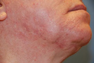Acne Scar Treatment Before & After Gallery - Patient 928948 - Image 2