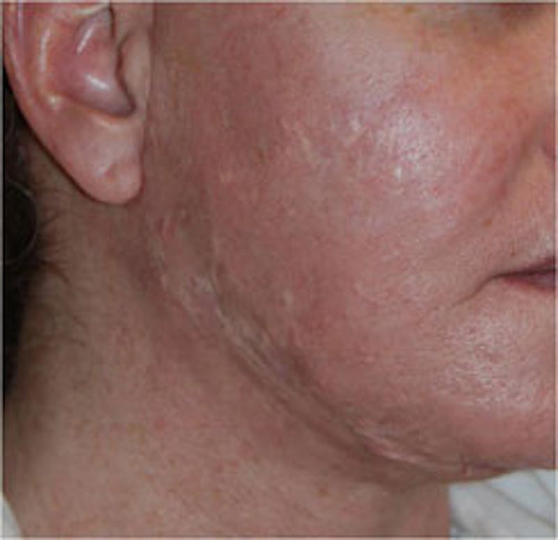 Scar Revision Before & After Gallery - Patient 428116 - Image 1