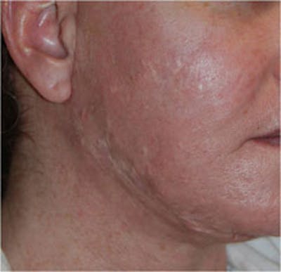 Scar Revision Before & After Gallery - Patient 428116 - Image 1