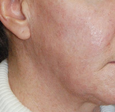 Scar Revision Before & After Gallery - Patient 428116 - Image 2