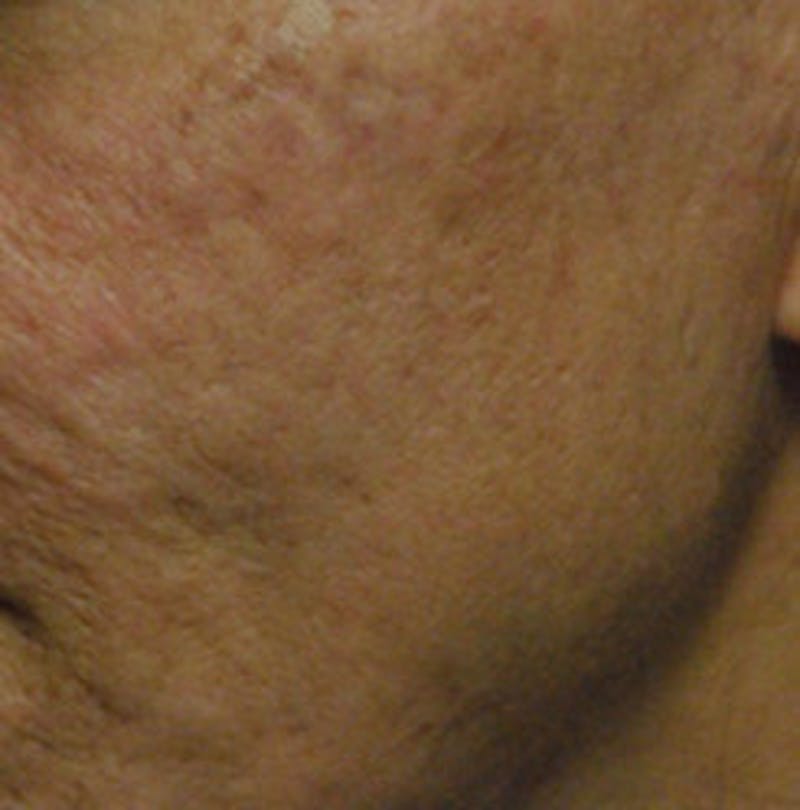 Laser Resurfacing Before & After Gallery - Patient 140345 - Image 1