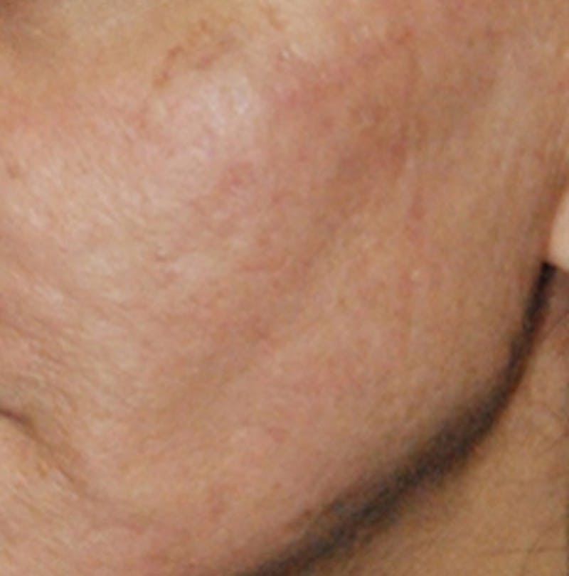 Laser Resurfacing Before & After Gallery - Patient 140345 - Image 2