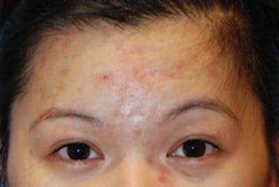 Acne Scar Treatment Before & After Gallery - Patient 411489 - Image 1
