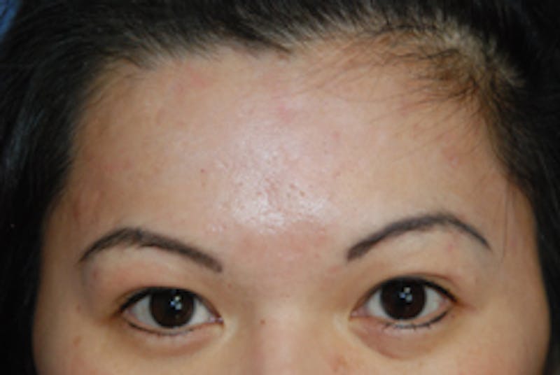 Scar Revision Before & After Gallery - Patient 978527 - Image 2
