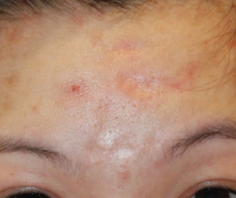 Scar Revision Before & After Gallery - Patient 978527 - Image 3