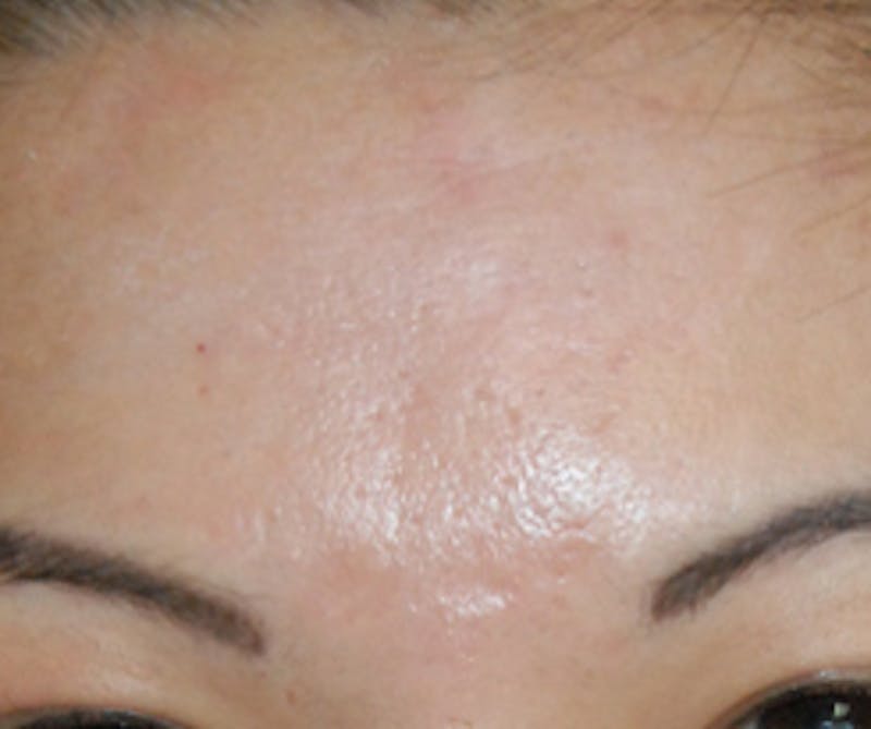Scar Revision Before & After Gallery - Patient 978527 - Image 4