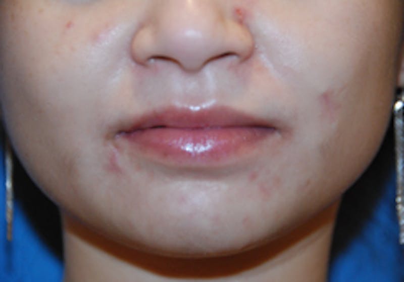 Scar Revision Before & After Gallery - Patient 978527 - Image 5