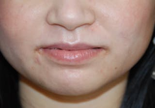 Scar Revision Before & After Gallery - Patient 978527 - Image 6