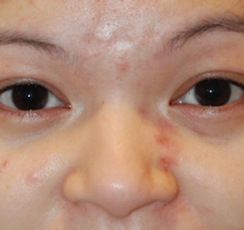 Scar Revision Before & After Gallery - Patient 978527 - Image 7