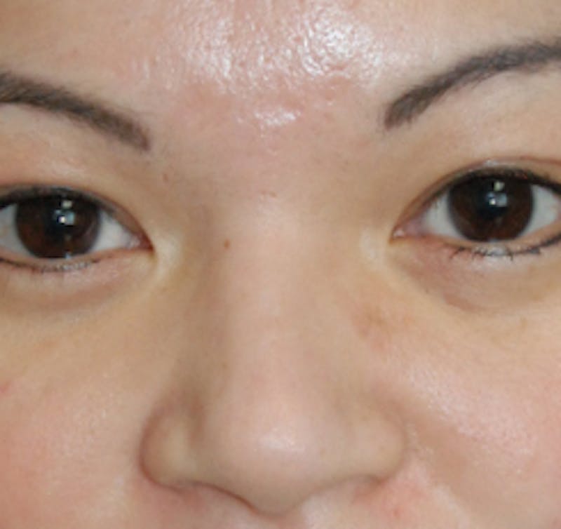 Scar Revision Before & After Gallery - Patient 978527 - Image 8