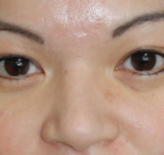 Scar Revision Before & After Gallery - Patient 978527 - Image 8
