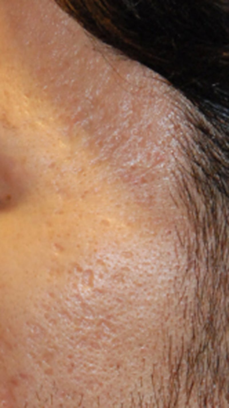 Acne Scar Treatment Before & After Gallery - Patient 347210 - Image 1