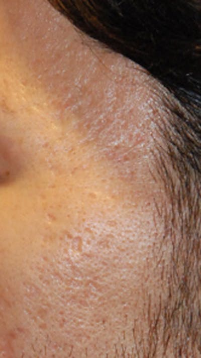 Acne Scar Treatment Before & After Gallery - Patient 347210 - Image 1
