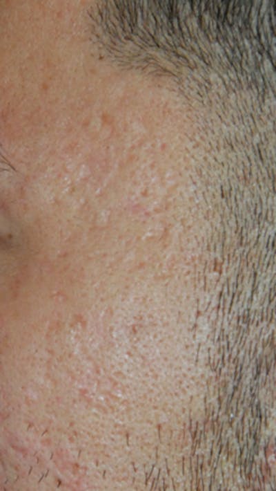 Acne Scar Treatment Before & After Gallery - Patient 347210 - Image 2