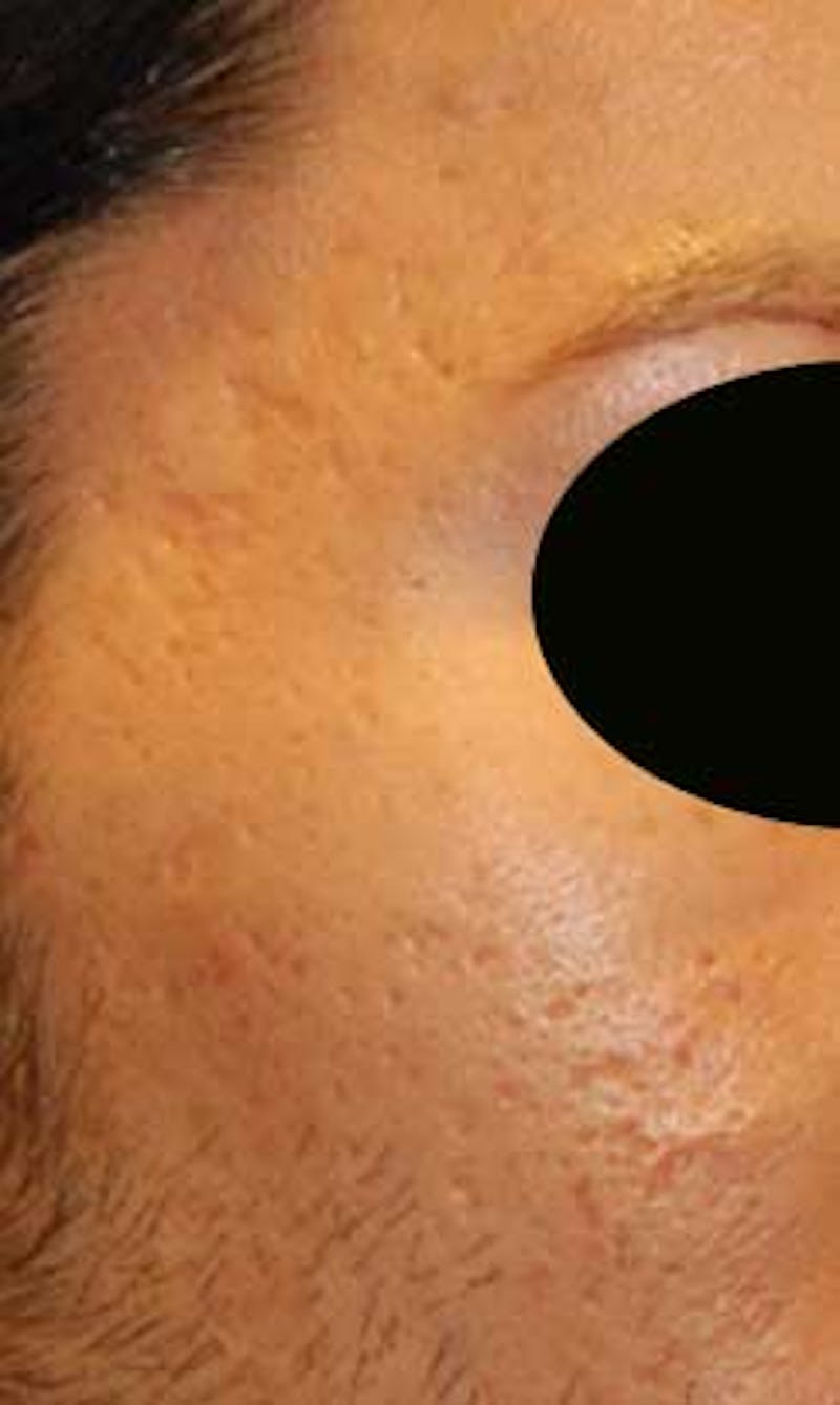 Acne Scar Treatment Before & After Gallery - Patient 347210 - Image 3