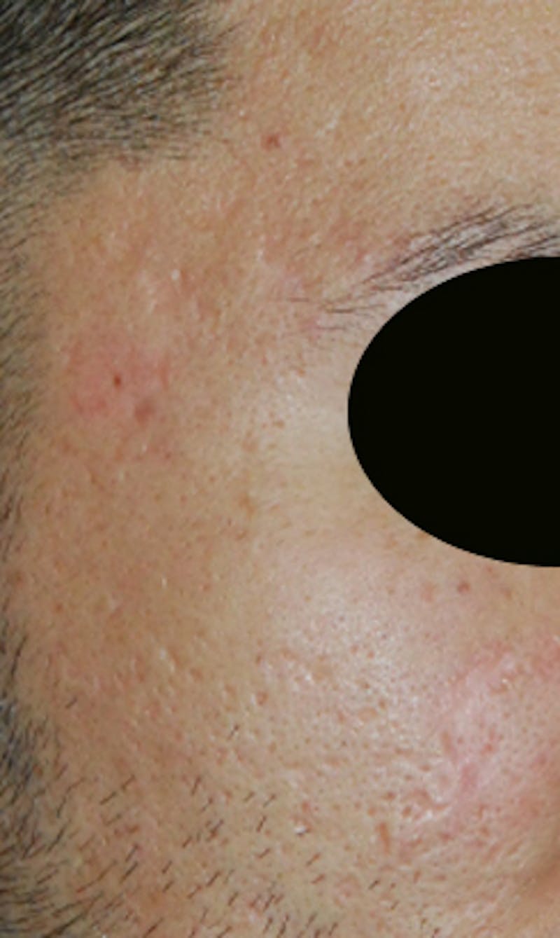 Acne Scar Treatment Before & After Gallery - Patient 347210 - Image 4