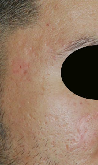 Acne Scar Treatment Before & After Gallery - Patient 347210 - Image 4