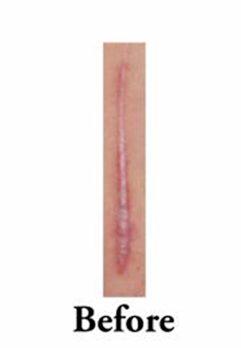Scar Revision Before & After Gallery - Patient 978527 - Image 9
