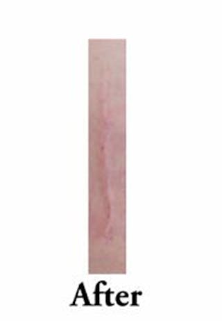Scar Revision Before & After Gallery - Patient 978527 - Image 10