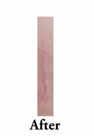 Acne Scar Treatment Before & After Gallery - Patient 255817 - Image 2