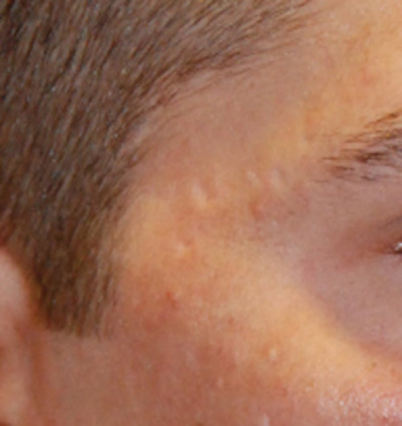 Scar Revision Before & After Gallery - Patient 215952 - Image 1