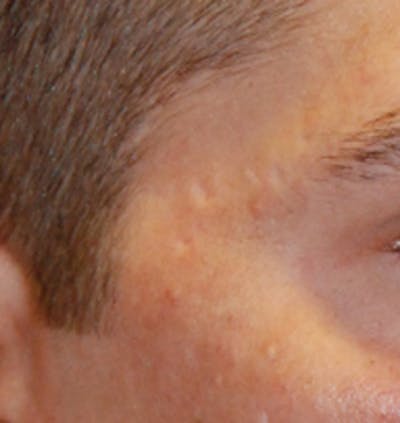 Acne Scar Treatment Before & After Gallery - Patient 153009 - Image 1