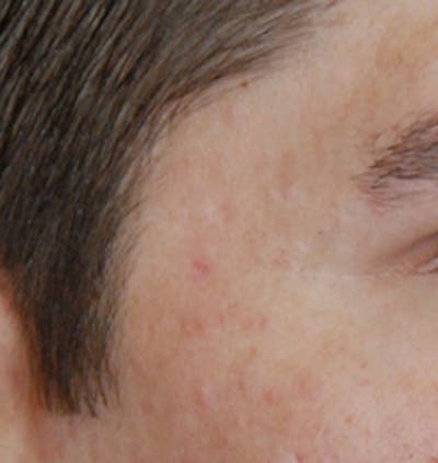 Acne Scar Treatment Before & After Gallery - Patient 153009 - Image 2