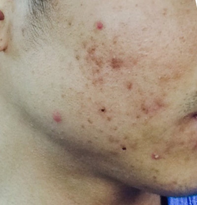 Chemical Peel Before & After Gallery - Patient 271436 - Image 1