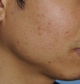 Acne Scar Treatment Before & After Gallery - Patient 378537 - Image 2