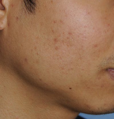 Acne Scar Treatment Before & After Gallery - Patient 378537 - Image 2