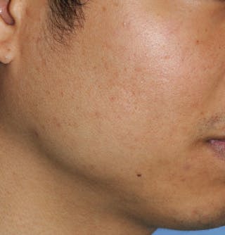 Acne Scar Treatment Before & After Gallery - Patient 378537 - Image 4