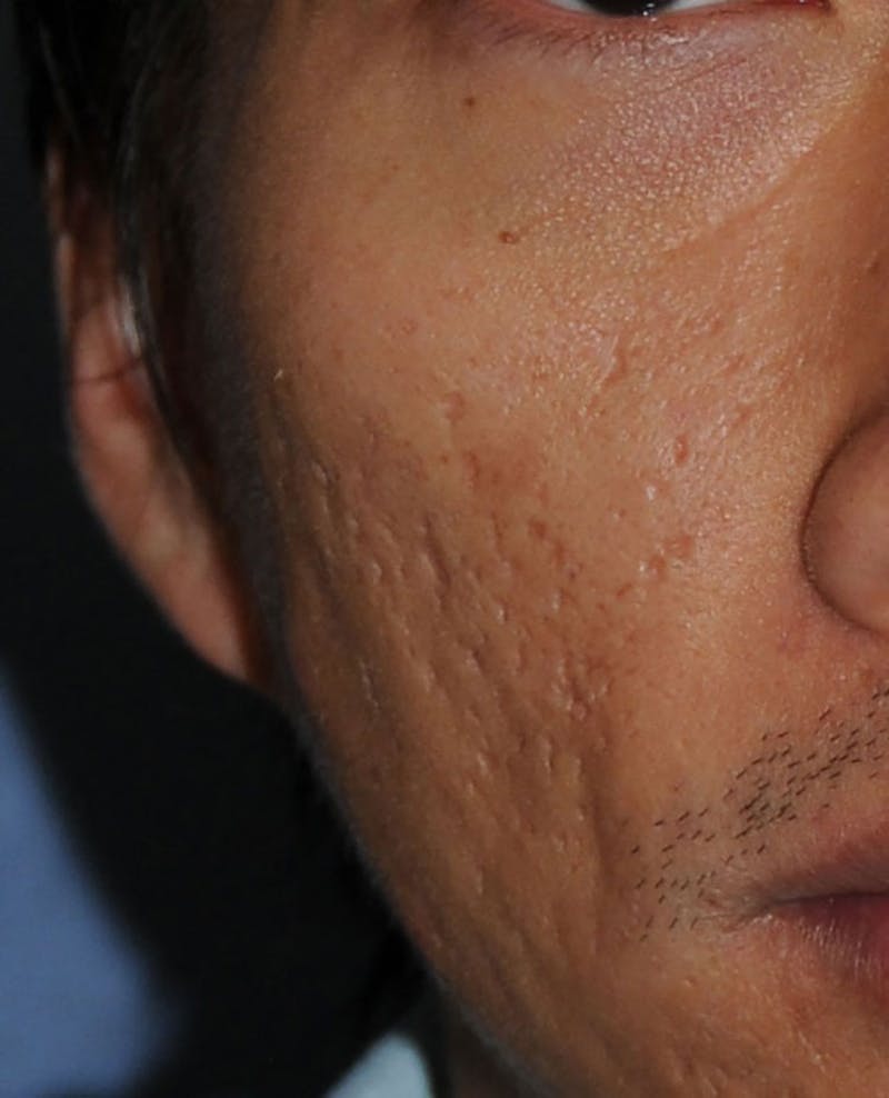 Acne Scar Treatment Before & After Gallery - Patient 332091 - Image 1