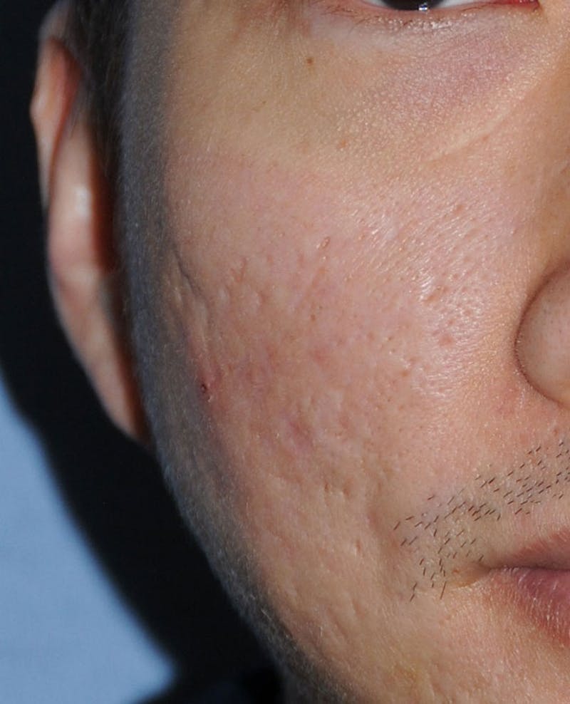 Acne Scar Treatment Before & After Gallery - Patient 332091 - Image 2
