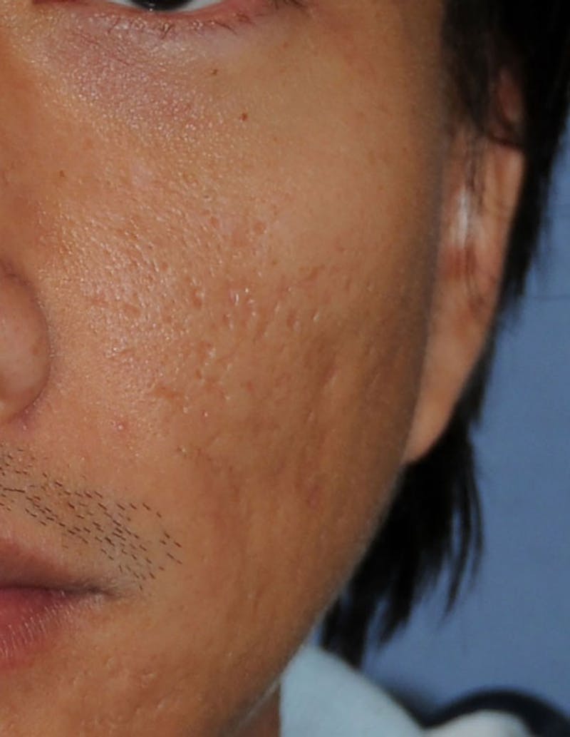 Acne Scar Treatment Before & After Gallery - Patient 332091 - Image 3