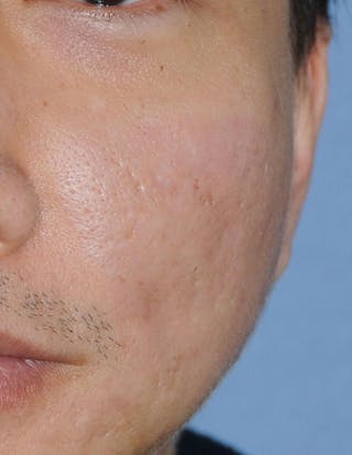 Acne Scar Treatment Before & After Gallery - Patient 332091 - Image 4