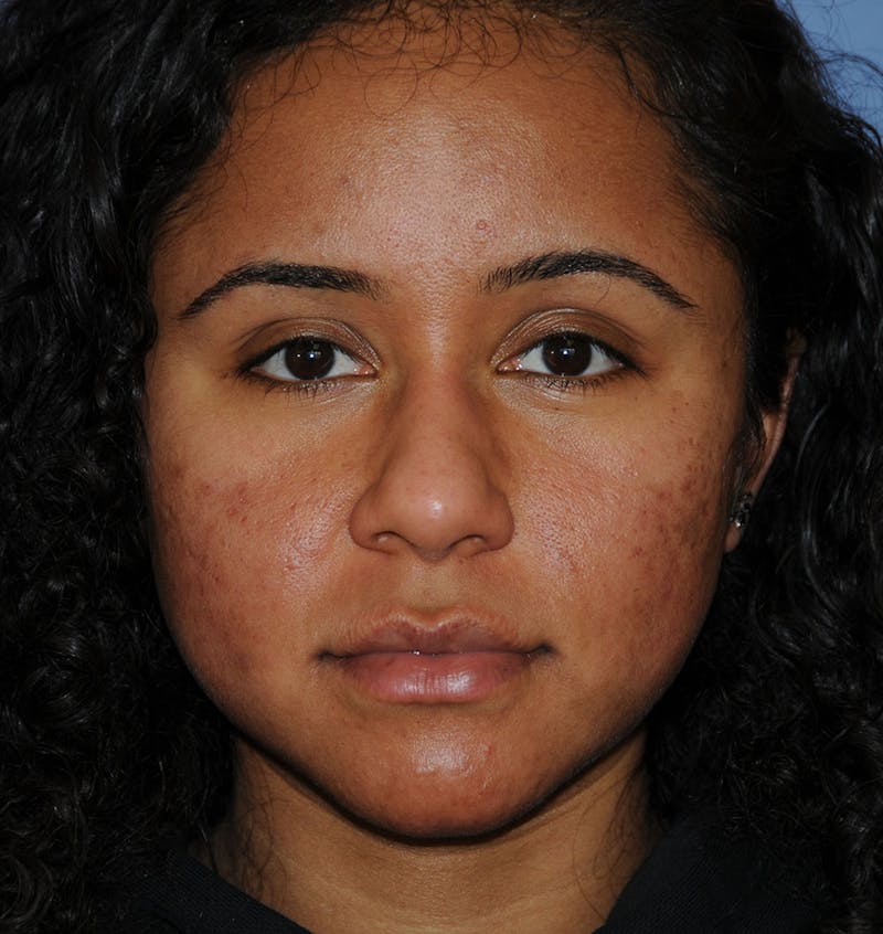 Acne Scar Treatment Before & After Gallery - Patient 103735 - Image 1