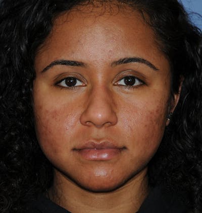 Acne Scar Treatment Before & After Gallery - Patient 103735 - Image 1
