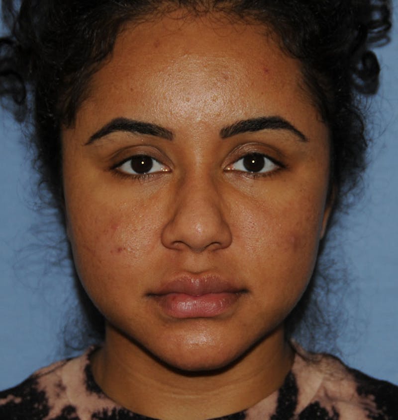 Acne Scar Treatment Before & After Gallery - Patient 103735 - Image 2