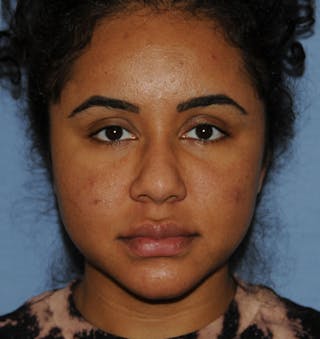 Acne Scar Treatment Before & After Gallery - Patient 103735 - Image 2