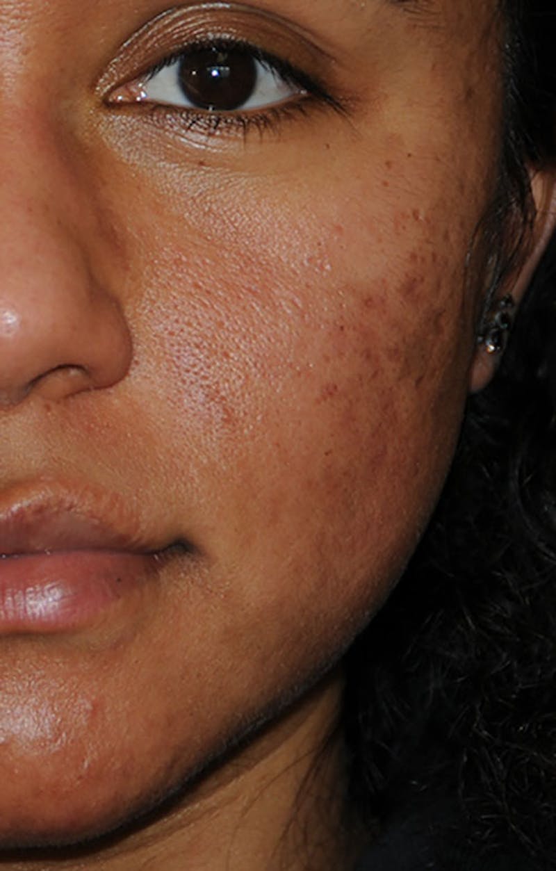 Acne Scar Treatment Before & After Gallery - Patient 103735 - Image 3