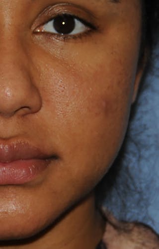 Acne Scar Treatment Before & After Gallery - Patient 103735 - Image 4