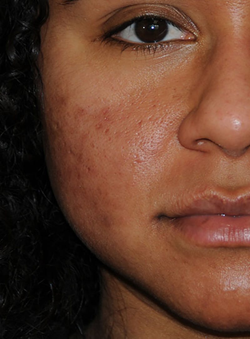 Acne Scar Treatment Before & After Gallery - Patient 103735 - Image 5
