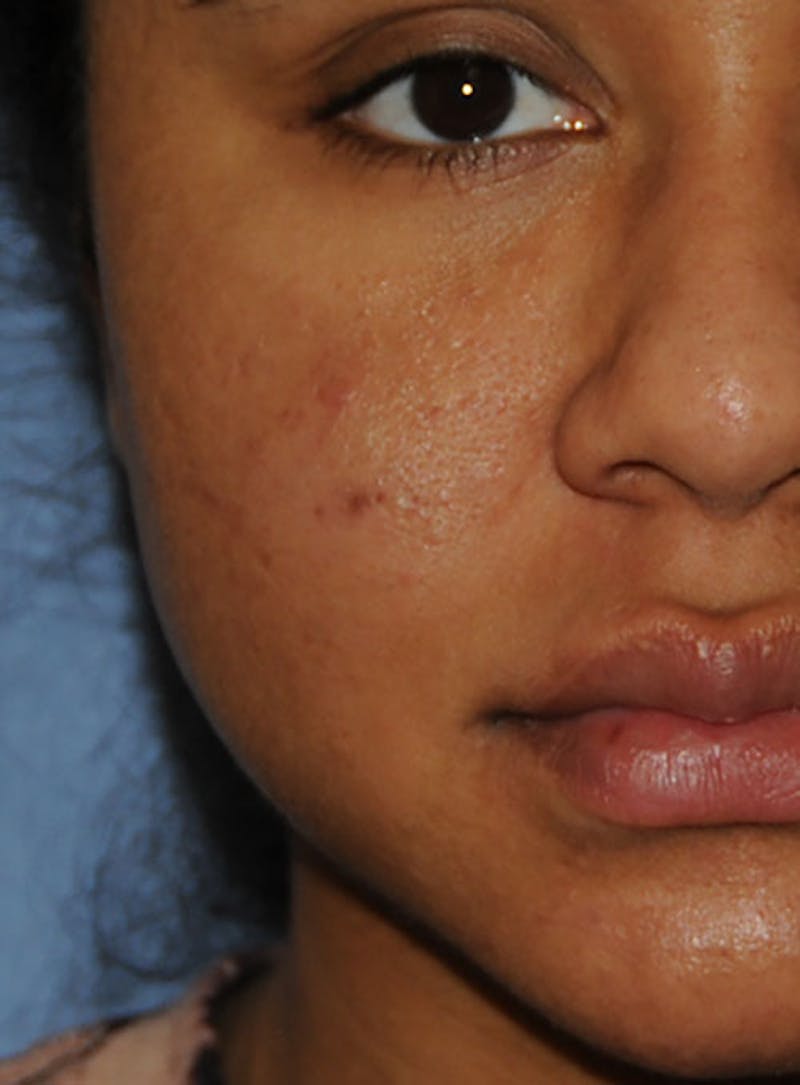 Acne Scar Treatment Before & After Gallery - Patient 103735 - Image 6