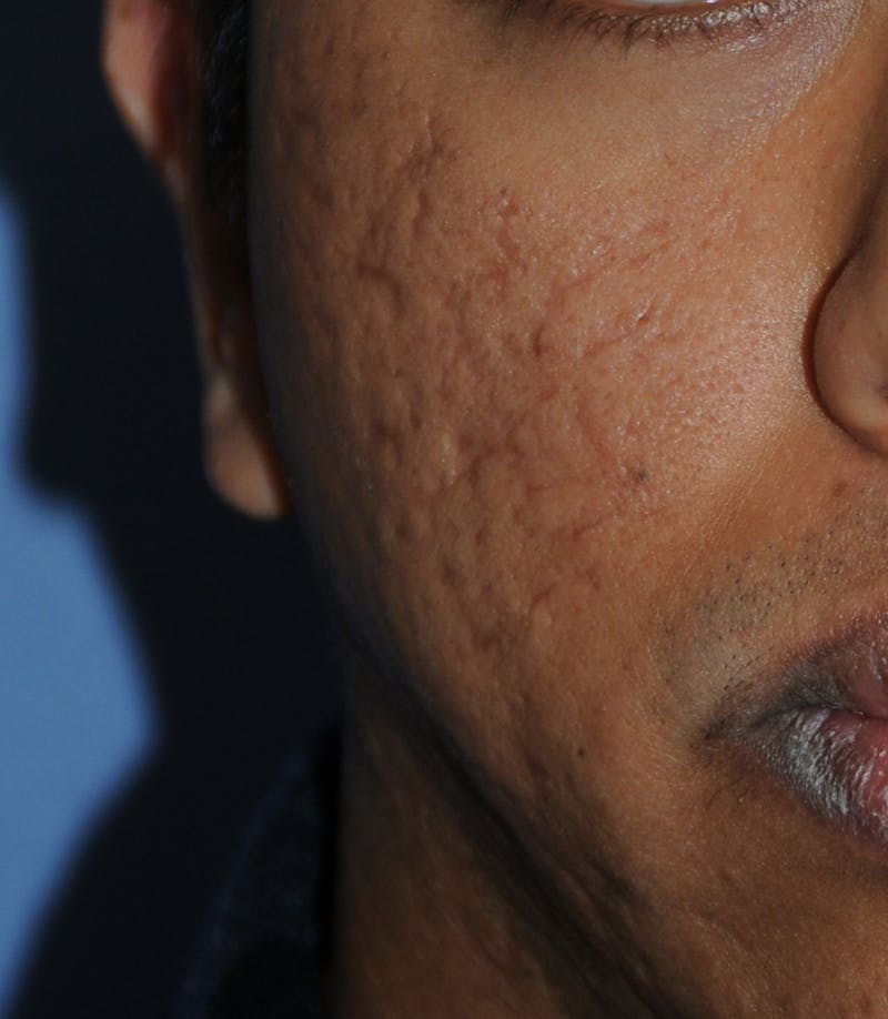 Acne Scar Treatment Before & After Gallery - Patient 181891 - Image 1