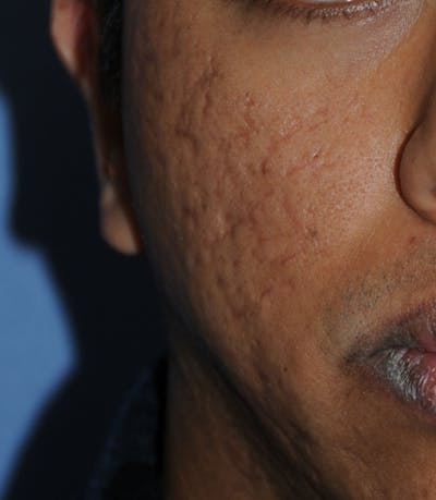 Acne Scar Treatment Before & After Gallery - Patient 181891 - Image 1