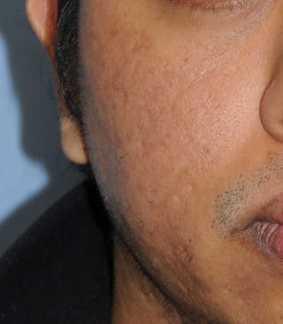 Acne Scar Treatment Before & After Gallery - Patient 181891 - Image 2