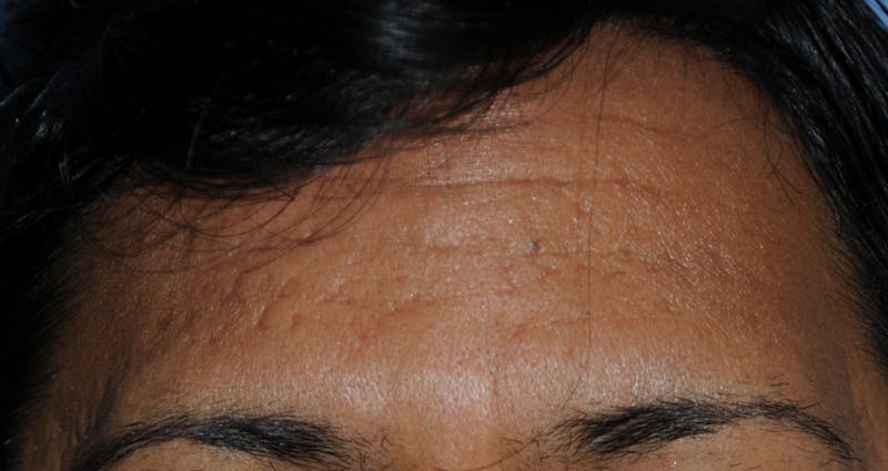Acne Scar Treatment Before & After Gallery - Patient 181891 - Image 3