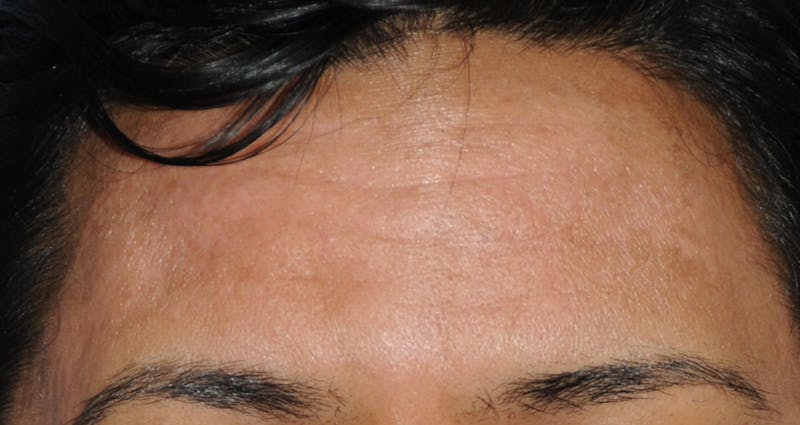 Acne Scar Treatment Before & After Gallery - Patient 181891 - Image 4